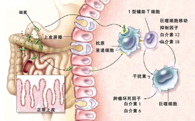 炎性肠病肛周病变.jpg 炎性肠病肛周病变.jpg
