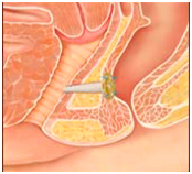 改良肛瘘栓填塞治疗高位复杂肛瘘1.png 改良肛瘘栓填塞治疗高位复杂肛瘘1.png