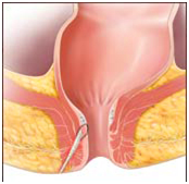 改良肛瘘栓填塞治疗高位复杂肛瘘.png 改良肛瘘栓填塞治疗高位复杂肛瘘.png