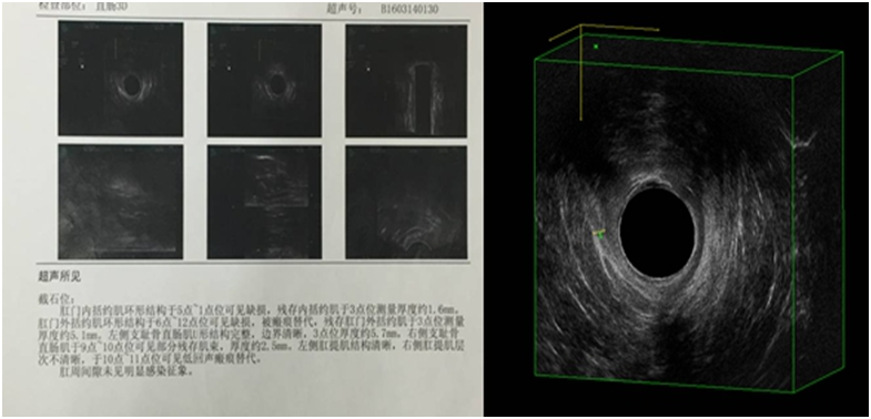 括约肌修复1.png 括约肌修复1.png