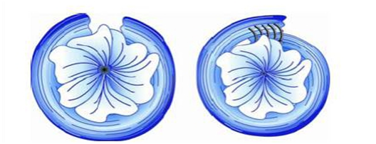 括约肌修复.png 括约肌修复.png