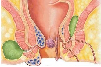 肛瘘.png 肛瘘.png