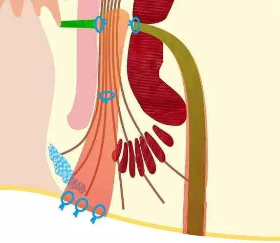 LIFT手术.jpeg LIFT手术.jpeg