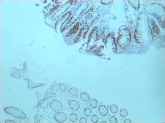 图一 免疫组化KI67异型腺体表达,正常腺体不表达.jpg 图一 免疫组化KI67异型腺体表达,正常腺体不表达.jpg