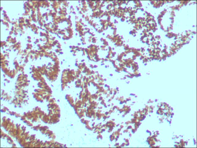 图二 免疫组化P53抑癌基因突变性表达.jpg 图二 免疫组化P53抑癌基因突变性表达.jpg