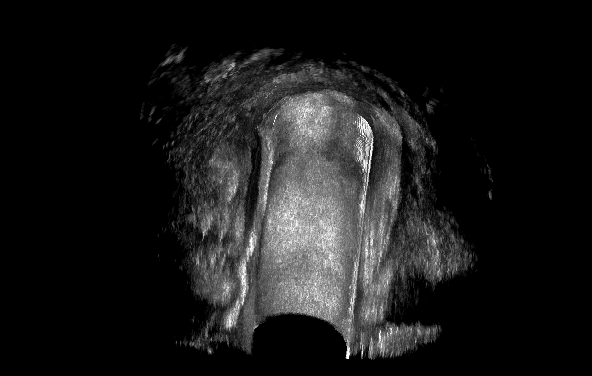 肛瘘过氧化氢增强造影1.bmp 肛瘘过氧化氢增强造影1.bmp