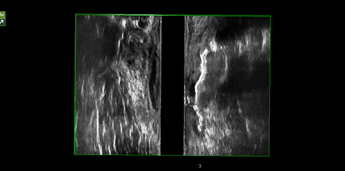 肛瘘过氧化氢增强造影2.bmp 肛瘘过氧化氢增强造影2.bmp