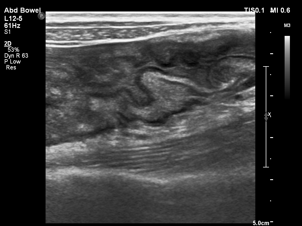 结肠超声1.jpg 结肠超声1.jpg