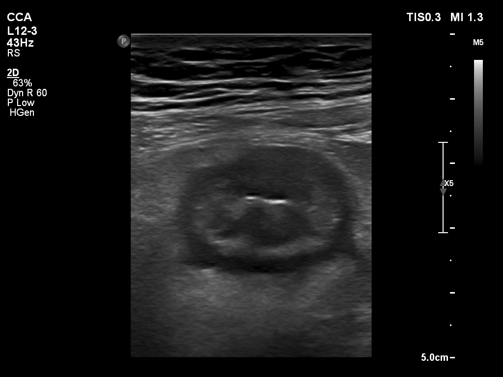 结肠超声2.jpg 结肠超声2.jpg