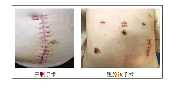 经肛门全直肠系膜切除术(TaTME)手术.jpg 经肛门全直肠系膜切除术(TaTME)手术.jpg