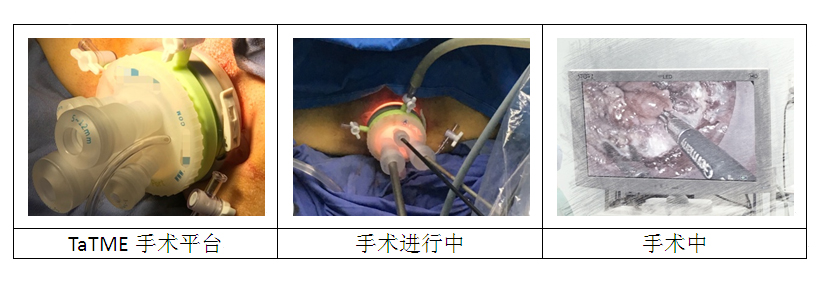 经肛门全直肠系膜切除术(TaTME)手术1.jpg 经肛门全直肠系膜切除术(TaTME)手术1.jpg